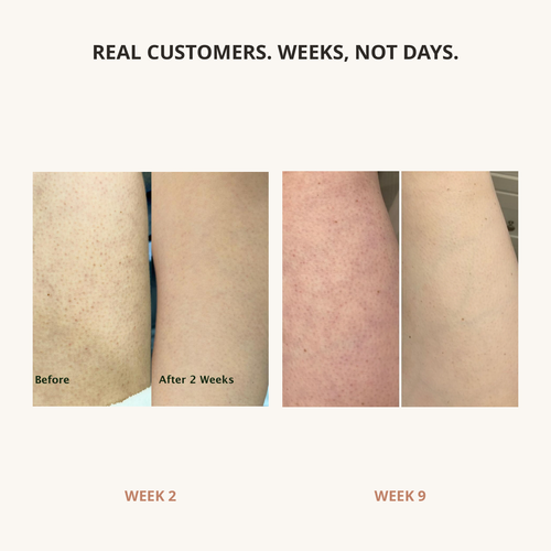 Mellowskin 42% Urea Cream for Keratosis Pilaris